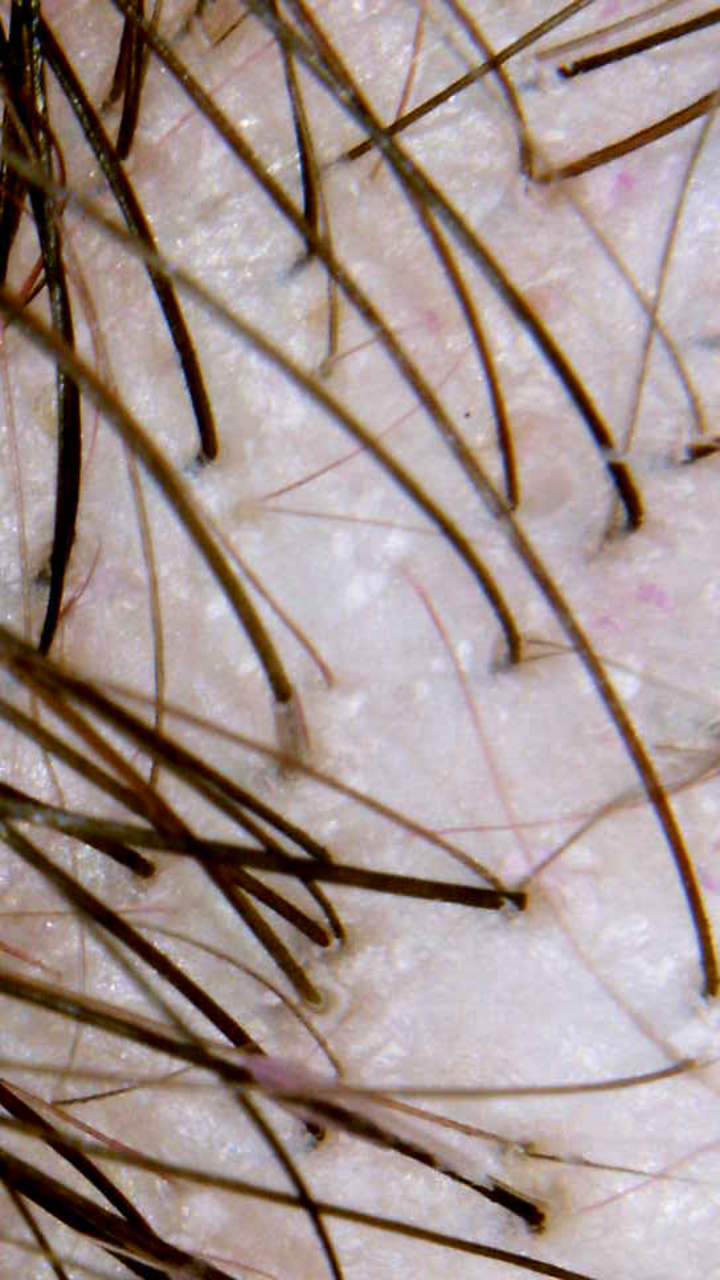 Detailed scalp imaging showing hair follicles